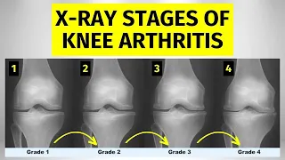X-ray Stages of Knee Arthritis