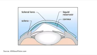 The Benefits of Scleral Contact Lenses