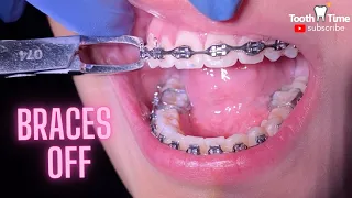 Braces off - What happens when you get your braces off - Tooth Time Family Dentistry New Braunfels