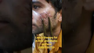 Dr.Salman# Best leech therapy centre#kubra Hijama.