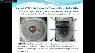 [Online Seminar] M. Jackson: Astigmatism Management: Pentacam® Technology in Cataract Surgery