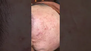 33- Deep blackheads vemoval by sovan