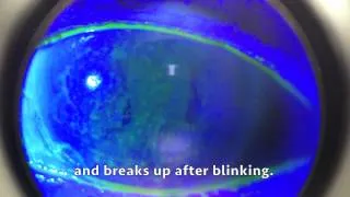 Dry Eyes: University Eye Specialists