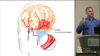 Need for Speed in LVO Stroke: The New Paradigm in Acute Stroke Treatment by Mark Ellis