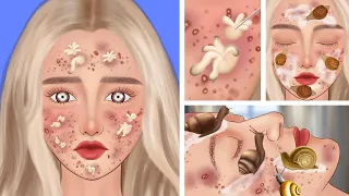 ASMR animation|Treat acne girl's face｜Remove blackheads and pimples