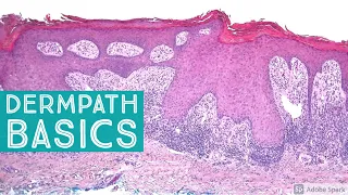 Basic Dermpath Cases - Explained by a Dermatopathologist