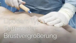 Lipödem Typ 1 Fettabsaugung Oberschenkel und Knie mit Fetttransfer in die Brüste