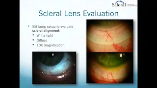 Scleral Lenses:   Basic to Advanced Troubleshooting
