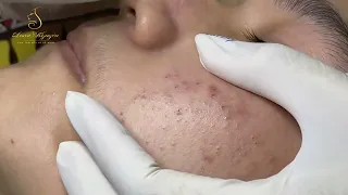 Loan Nguyen Acne Treatment 15411