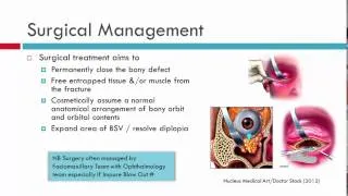 Blow Out Fracture Management