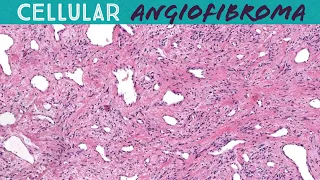 Cellular Angiofibroma of the Genitals - a relative of spindle cell lipoma (Yale case 2) pathology