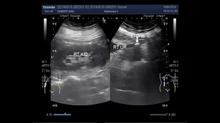 Ultrasound Video showing two cases of ureteric stone.