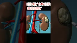 Kidney Cancer Surgery #kidney #cancer #kidneystone #shorts #innovation