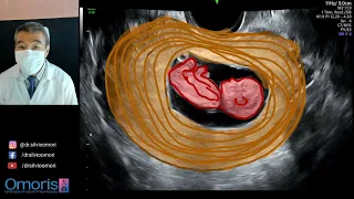 BLEEDING in the first trimester. Pregnancy 10 weeks. 3D 4D images.