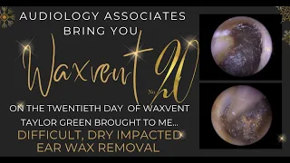 DIFFICULT, IMPACTED DRY EAR WAX REMOVAL - EP539