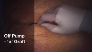 Off-Pump Beating Heart Bypass Surgery - π (pi) graft