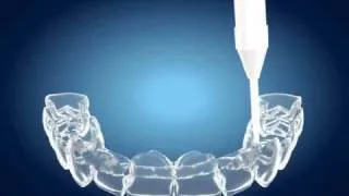 Tooth Whitening - Home Bleaching