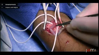Arteriovenous Fistula Creation (Links to Full Procedure)