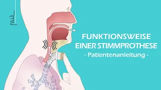 Funktionsweise einer Stimmprothese | Animation |  Fahl Medizintechnik-Vertrieb GmbH