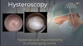 Hysteroscopic Myomectomy and challenging cervix