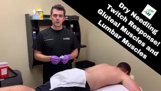 Dry Needling Twitch Response Gluteal Muscles and Lumbar Muscles