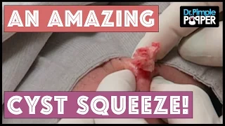 A Really AMAZING Left Cheek Cyst Squeeze!!