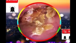 Compilation Of Earwax Removal Video | 耳垢除去ビデオの編集