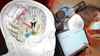 Experimental brain implant treats woman's depression