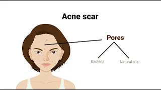 The Different Types of Acne Scars: Explanations, Diagnosis & Treatment Recommendations.