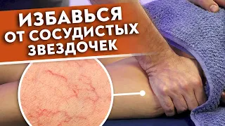 Как убрать сосудистую сетку на ногах? Массаж от сосудистых звёздочек