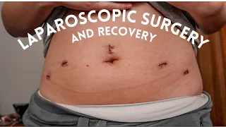 Diagnostic Laparoscopic Surgery and Recovery l Excision Surgery l Removal of Endometriosis l