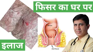 Fissure Treatment at Home in Hindi | Fissure Treatment in Homeopathy | Fissure Ano Symptoms