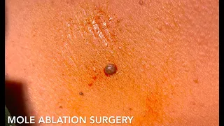 Scarless Mole Removal Using Radiofrequency Ablation