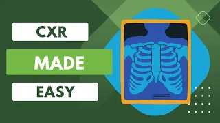 How to Read Chest Xray || Chest Xray Made Easy