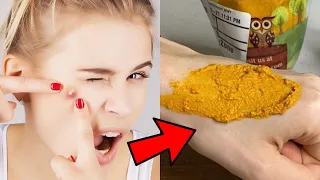 2 Ingredients Remove Acne Forever and Tighten Skin