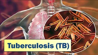 Tuberculosis (TB)  I Causes, Symptoms, Prevention, & Treatment