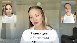 7 месяцев с брекетами 🦷  ФОРМА ЛИЦА ИЗМЕНИЛАСЬ? || ЧТО СКАЗАЛА ОРТОДОНТ?