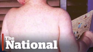 Quebec measles cases linked to Disneyland outbreak