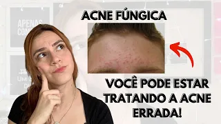 COMO SABER SE TENHO ACNE FÚNGICA - como tratar e como prevenir a acne fúngica