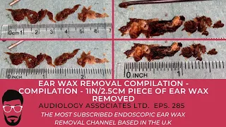 EAR WAX REMOVAL COMPILATION - 1IN/2.5CM PIECE OF EAR WAX REMOVED - EP 285