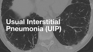 Usual Interstitial Pneumonia (UIP)