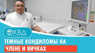 👦 Темные кондиломы на члене и яичках. Клинический случай №214