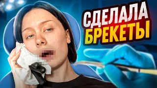 У МЕНЯ ТЕПЕРЬ БРЕКЕТЫ! (операция, гнилые зубы и боль)