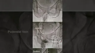 Treatment of erectile dysfunction caused by Venous leakage by interventional coil embolization