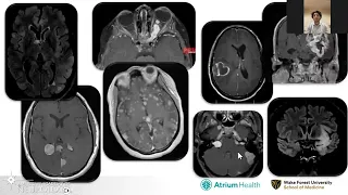 VRELS: Brain Tumor Management for the Neurologist - American Academy of Neurology