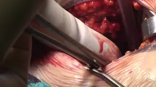 Treatment of femoral pseudoaneurysm