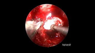 Acromegaly - Endoscopic EndonasalTranssphenoidal Selar Approach