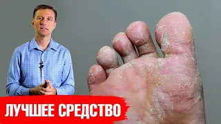 Как избавиться от грибка стопы? Средство от стопы атлета🔥