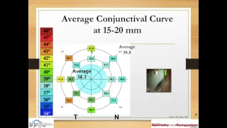 Fitting and Troubleshooting Scleral Lenses Part 1