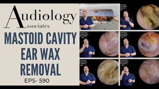 MASTOID CAVITY EAR WAX REMOVAL - EP590